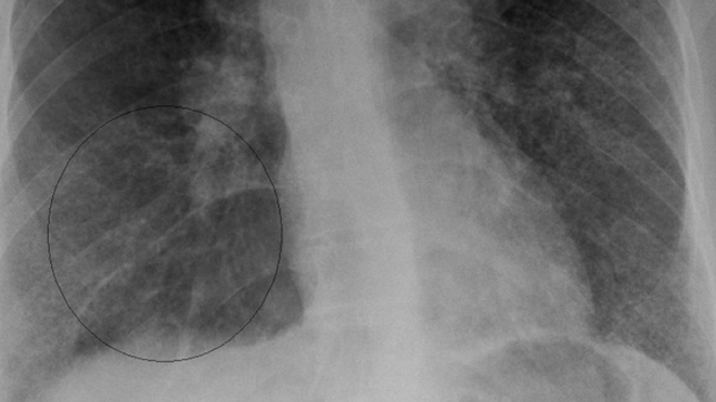 Radiographie du thorax d'une personne atteinte de sarcoïdose, la zone cerclée présente une accumation de granulomes. (cc-by-sa Jmh649)