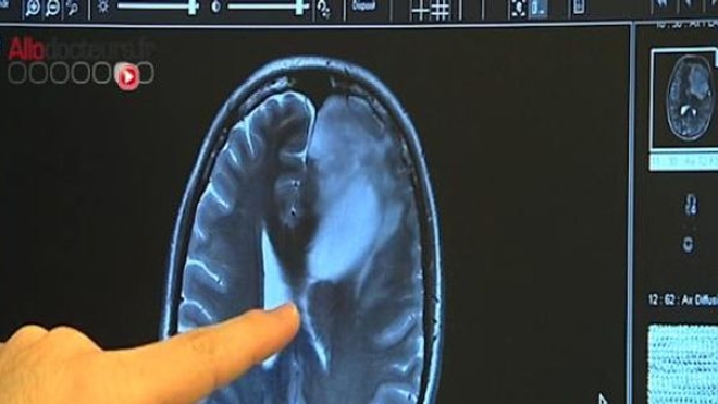 Tumeurs du cerveau : ce que peut la chirurgie