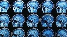 Des médicaments pour la ménopause ou l'endométriose augmentent le risque de tumeur cérébrale