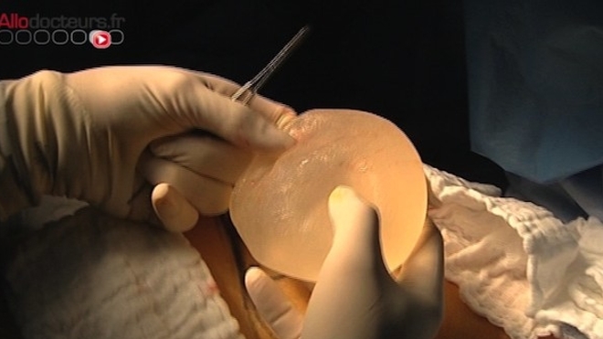 La France interdit plusieurs modèles de prothèses mammaires