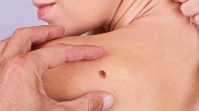 Cancers de la peau : cette semaine, faites-vous dépister !