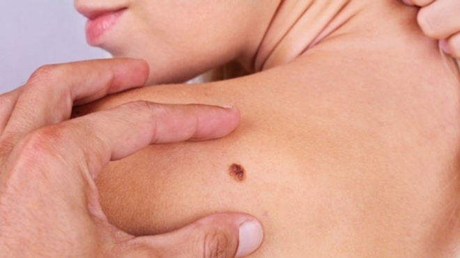 L’intérêt du dépistage du cancer de la peau mis en cause 