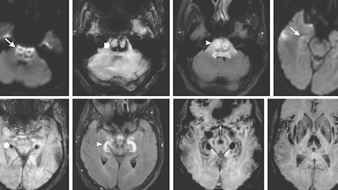 IRM cérébraux du patient décédé lors de l'essai clinique de Rennes. (doi:10.1056/NEJMoa1604221)