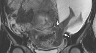 Lorsque le foetus se développe en partie hors de l'utérus