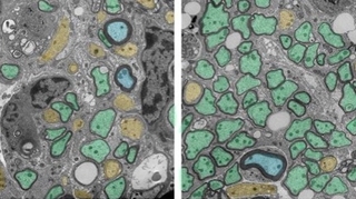 Sclérose en plaques : quand les globules blancs aident à réparer la myéline