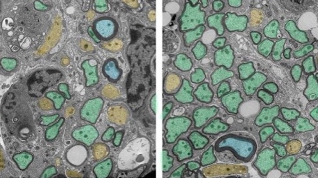 Sclérose en plaques : quand les globules blancs aident à réparer la myéline
