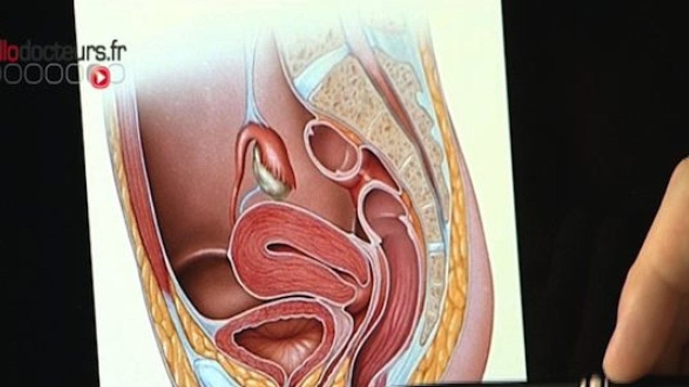 Incontinence urinaire de l'homme : mieux comprendre