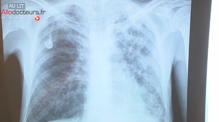 Tuberculose : un enfant décède dans le département de la Vienne