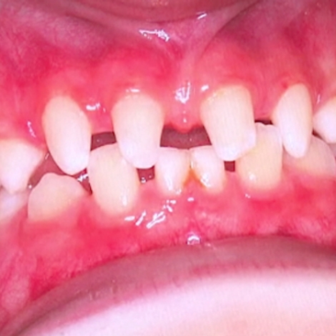 Agénésie dentaire, quand les dents manquent