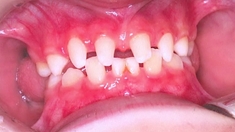 Agénésie dentaire, quand les dents manquent