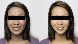 Chirurgie esthétique : quand les patients veulent ressembler à leur photo retouchée