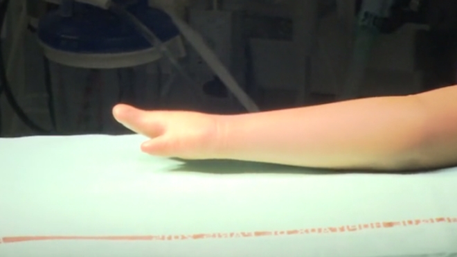 Nouvelle enquête sur les bébés nés avec une malformation des bras : une décision "encourageante" pour les familles