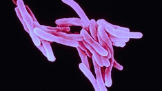 Les cas de tuberculose en hausse à cause du Covid