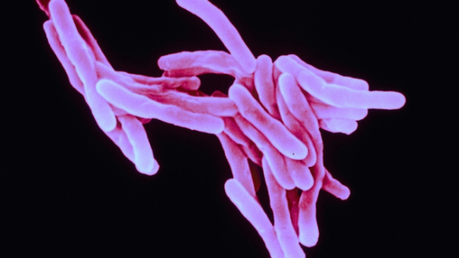 Forte progression de la tuberculose en Île-de-France