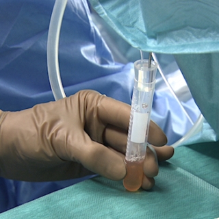 Le don d'ovocytes, comment ça marche ?