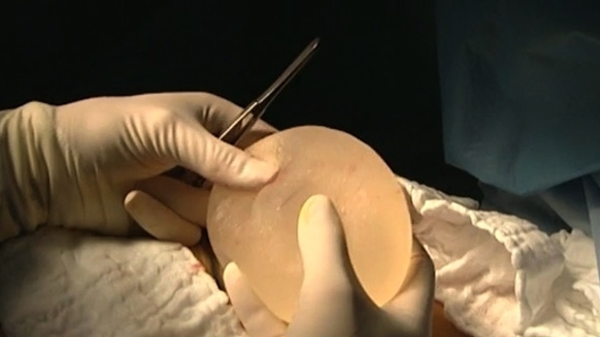 Les implants mammaires texturés Allergan retirés du marché