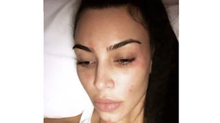 Kim Kardashian dévoile des photos de son psoriasis