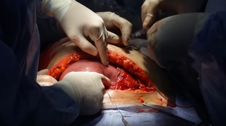 Spina bifida : impressionnante vidéo d’un foetus opéré in utero