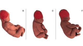 Déformations du crâne du bébé lors de l'accouchement : précieux indices de leur état de santé ?