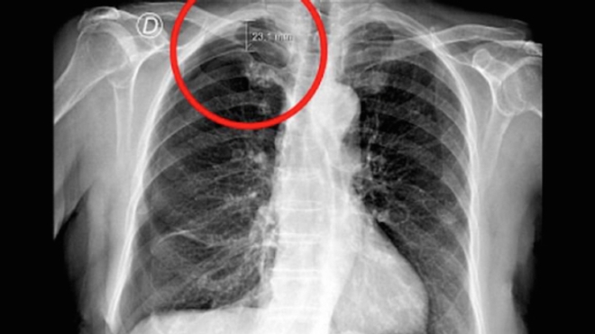 Le pneumothorax est mis en évidence dans le cercle rouge. Il correspond à une poche d'air de 23 mm entre le poumon et la cage thoracique.