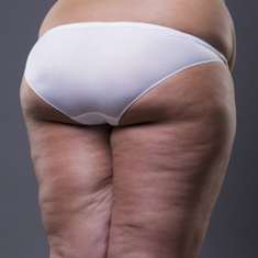 Le lipoedème, une maladie du tissu graisseux