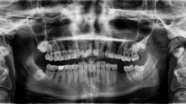 En Inde, des médecins retirent 526 dents de la bouche d’un enfant !
