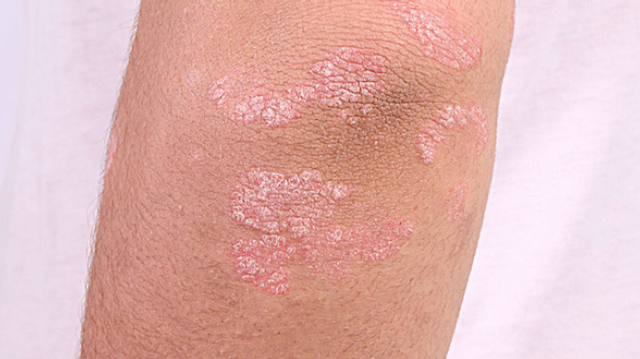 Psoriasis : quels traitements, quels progrès ? - AlloDocteurs