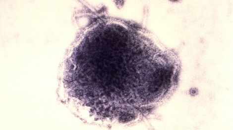 Rougeole : le virus continuerait de nuire au système immunitaire après l'infection