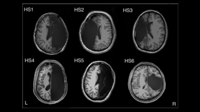 Images des six cerveaux ayant subi une hémisphérectomie.