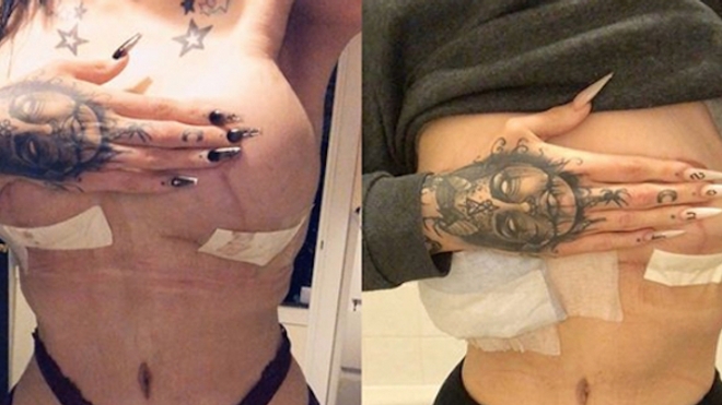Avant le retrait des implants mammaires (à gauche) et après le retrait (à droite).