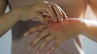 Covid : les dermatologues alertent sur des symptômes cutanés
