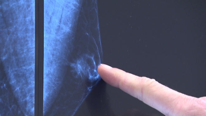 Cancer du sein : les hommes aussi