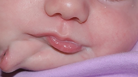 Diprosopie : un bébé nait avec deux bouches