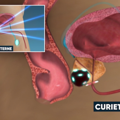 La curiethérapie, une radiothérapie ciblée pour traiter les cancers