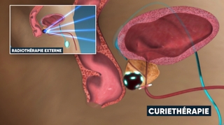 La curiethérapie, une radiothérapie ciblée pour traiter les cancers