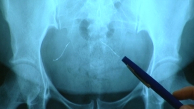 Image d'illustration. Visualisation sur une radiographie de l'abdomen de deux implants Essure.