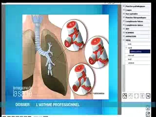 Asthme: les explications en images