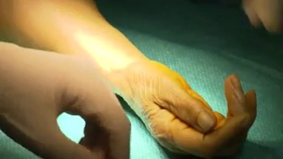 Attention images de chirurgie ! Comment se déroule la trapézectomie