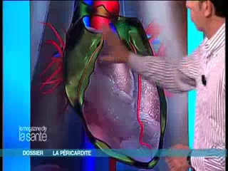 La péricardite en images