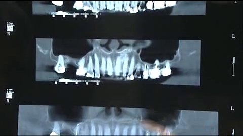 Attention, images de chirurgie ! Quand l'os du maxillaire est trop mince pour supporter les implants, la greffe osseuse est indispensable.