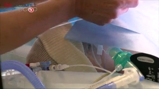 Attention, images de chirurgie : opération à coeur ouvert pour traiter une tétralogie de Fallot