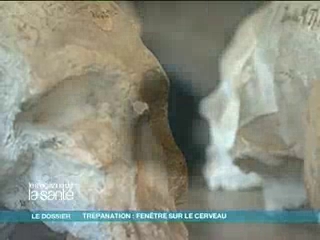 La trépanation : une technique qui a traversé des siècles