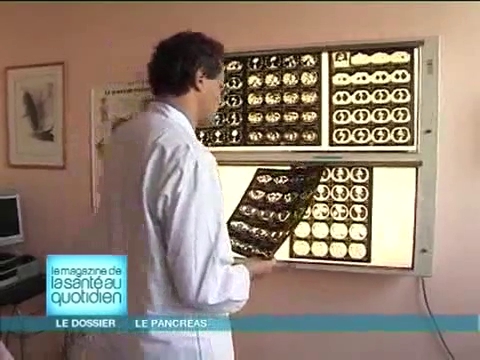 Attention, images d'intervention chirurgicale : le chirurgien retire la partie malade du pancréas.