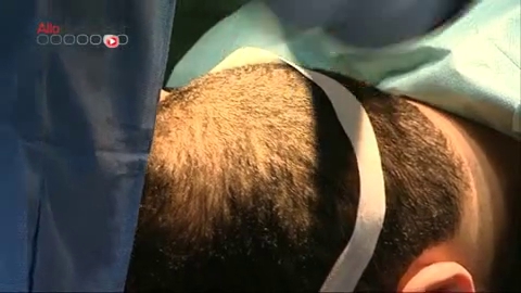La greffe d'implants capillaires, à quoi ça ressemble ? La réponse en images