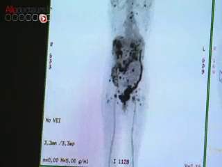 L'hysterectomie se déroule sous coelioscopie.