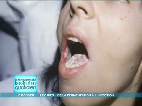 La candidose ou la mycose vaginale sont des infections causées par une levure.