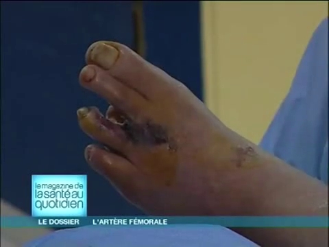 Attention, images d'intervention chirurgicale : le chirurgien utilise une veine pour remplacer l'artère malade.