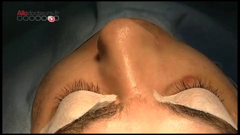 Attention images de chirurgie. Lorsque les os du nez sont cassés, il est recommandé d'intervenir assez rapidement. On parle alors de réduction de fracture.