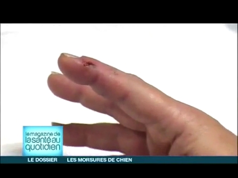 Attention, images d'intervention chirurgicale : il faut veiller à ce que les tendons ne soient pas touchés par la morsure.