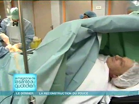 Attention, images d'intervention chirurgicale : une partie du gros orteil est prélevée pour reconstruire le pouce.